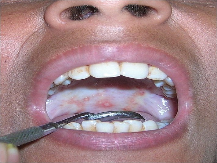 Oral Submucous Fibrosis